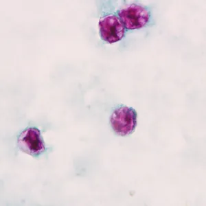 Cyclospora cayetanensis oocysts stained with modified acid-fast stain in a stool smear